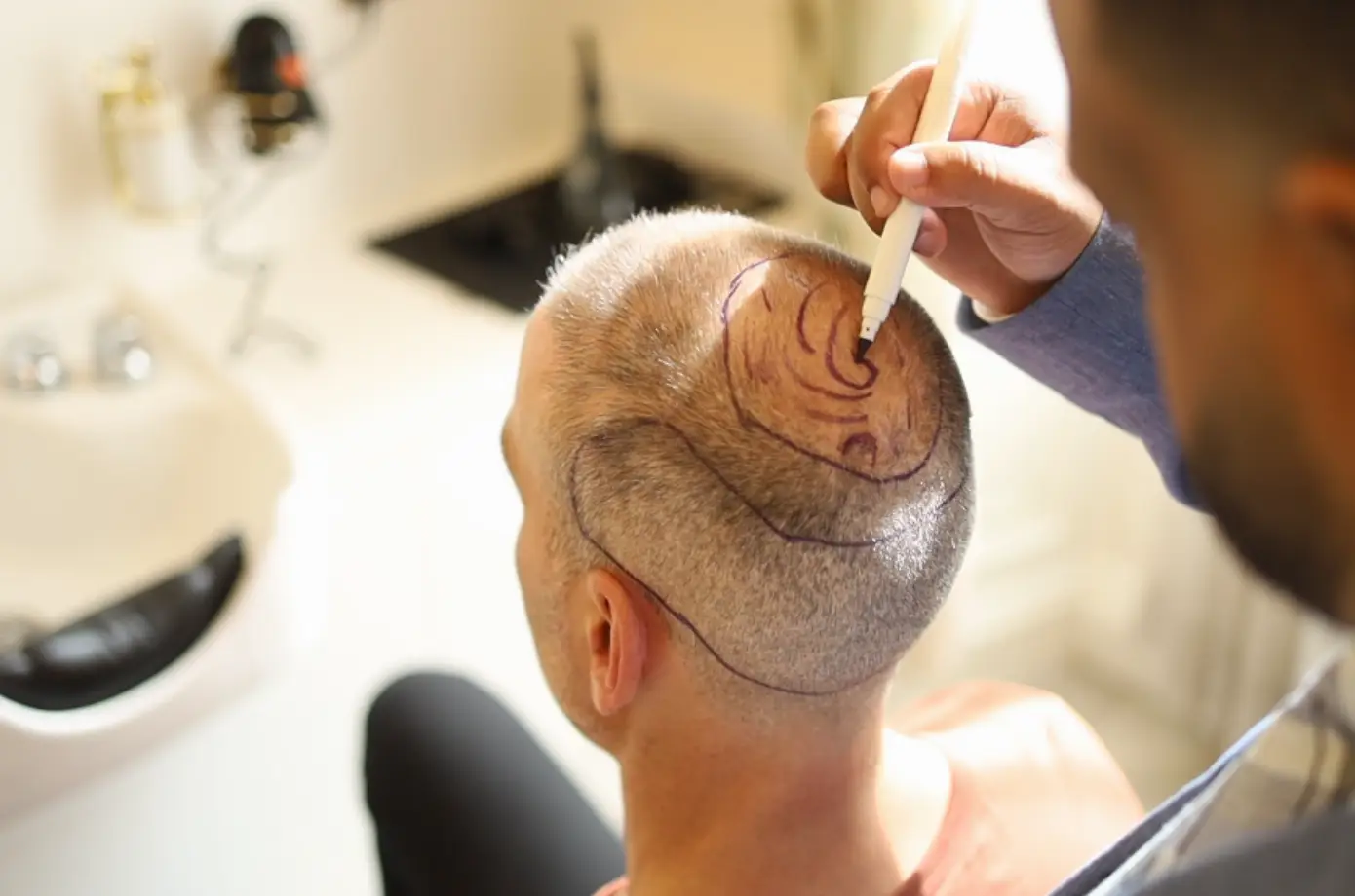 hair-transplant-drawing-the-lines